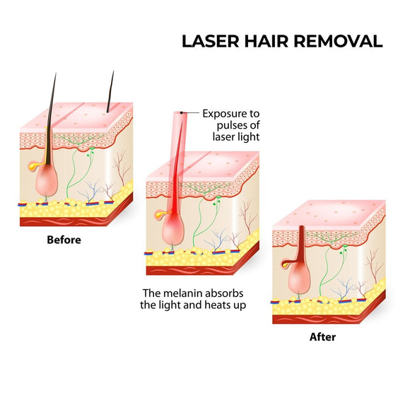 Silhouette Portable Laser Hair Remover Permanent Epliation System Body Face Home - RnR Galore