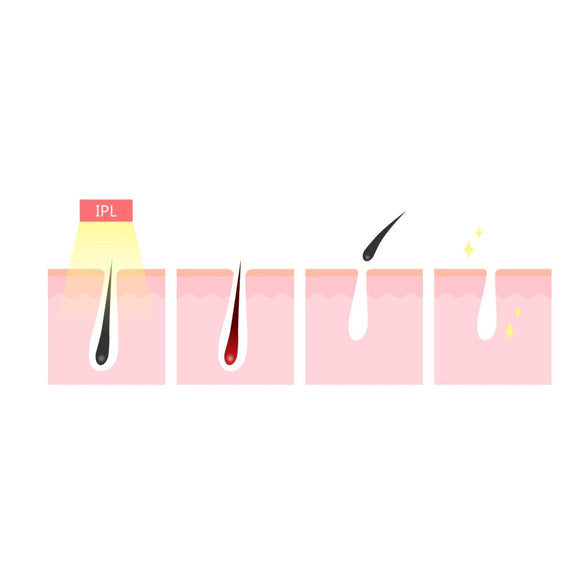 Silhouette Portable Laser Hair Remover Permanent Epliation System Body Face Home - RnR Galore